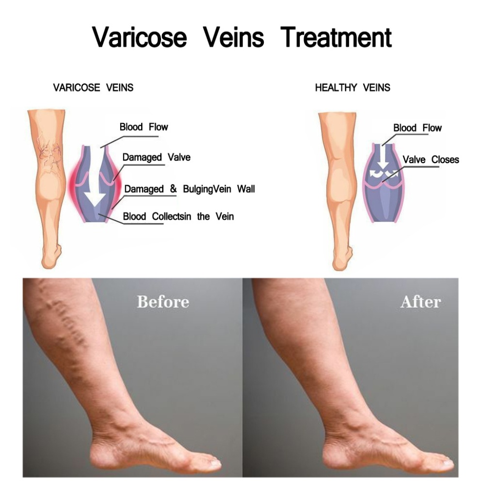 Varicose Ointment Body Care for Veins Flat Soft - Image 2