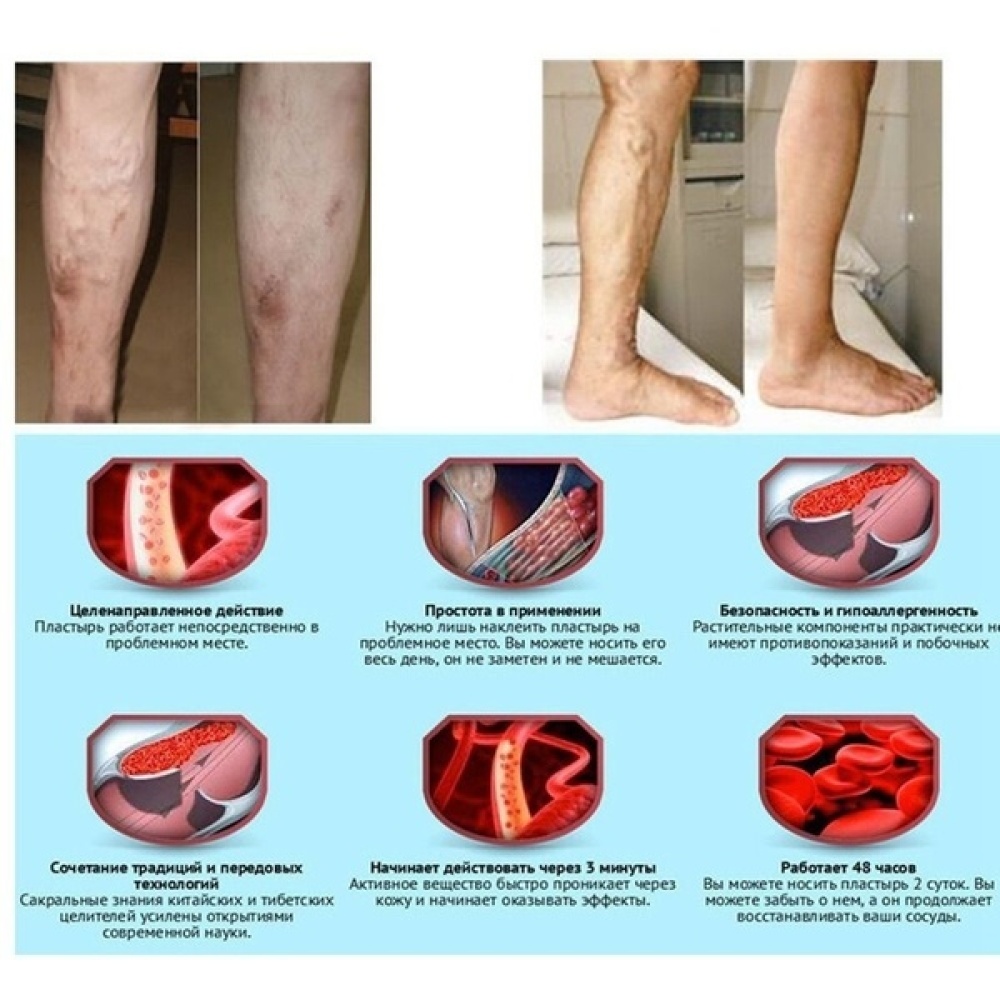 Varicose Veins Ointment Vasculitis Treatment Phlebitis Angiitis Inflammation Blood Vessel Rotten Legs Cream - Image 3