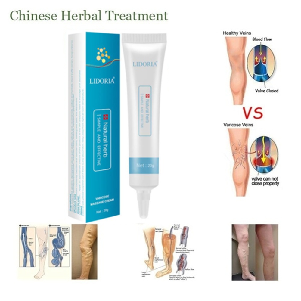 Varicose Veins Ointment Vasculitis Treatment Phlebitis Angiitis Inflammation Blood Vessel Rotten Legs Cream - Image 2